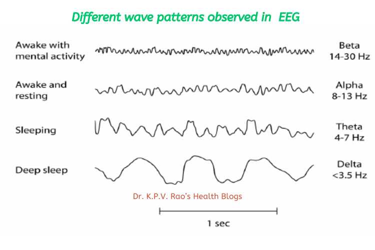 EEG picture used to diagnose Epilepsy