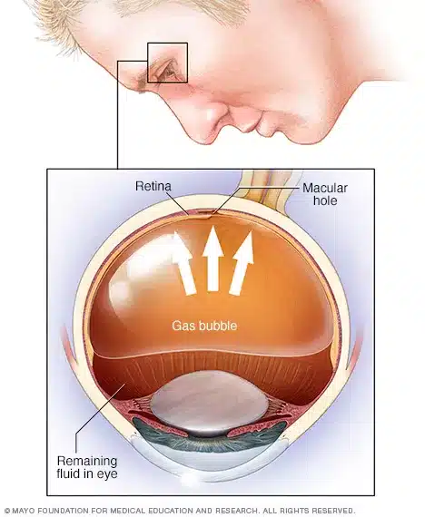 Treatment of retinal detachment by pnuematic retinopexy