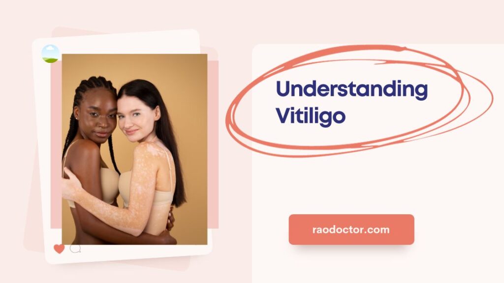 Feature Image for the article on Vitiligo