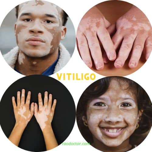 Vitiligo on hands and face