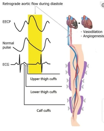 Image showing how EECP works
