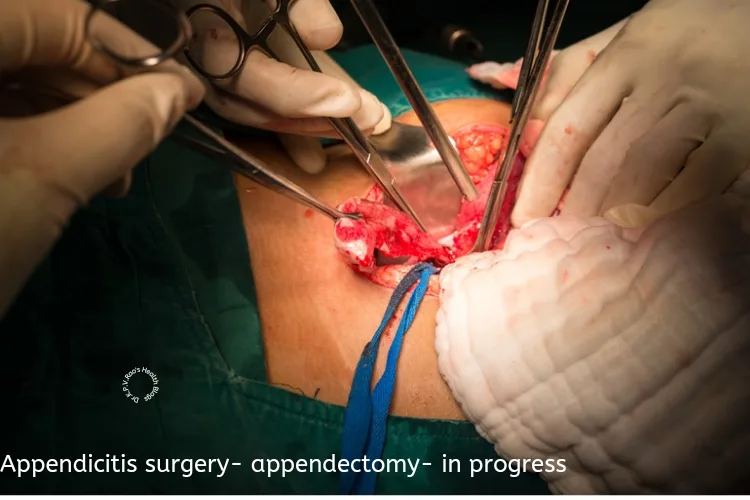 Appendicitis surgery 