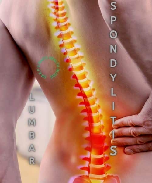 Featured image for the article on lumbar spondylitis