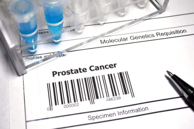Image showing prostate cancer tests