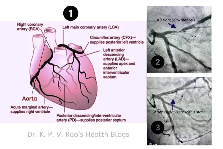 Imagen que muestra arterias coronarias en el corazón y angiografía cardíaca.