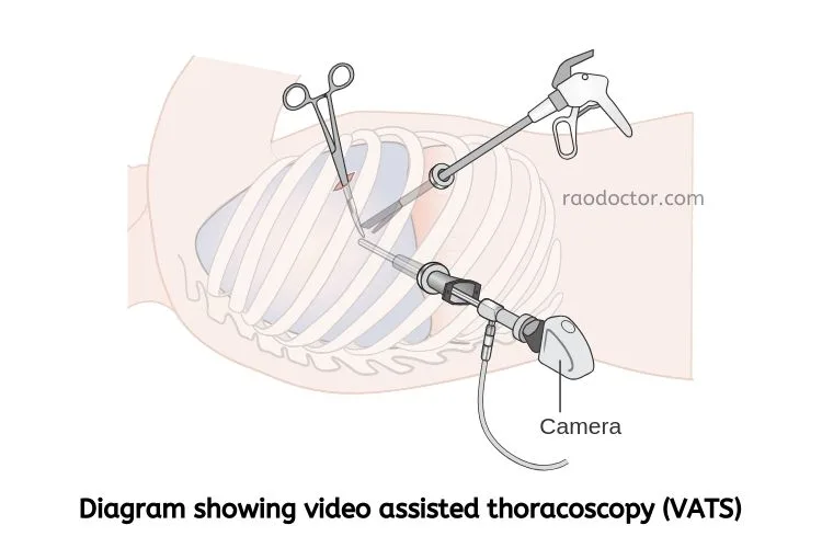 A diagram showing Video assisted thoracoscopy[ VATS]