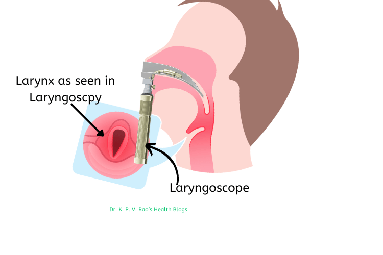 Diagrama de una persona sometida a una laringoscopia realizada por un otorrinolaringólogo que muestra la laringe en el recuadro