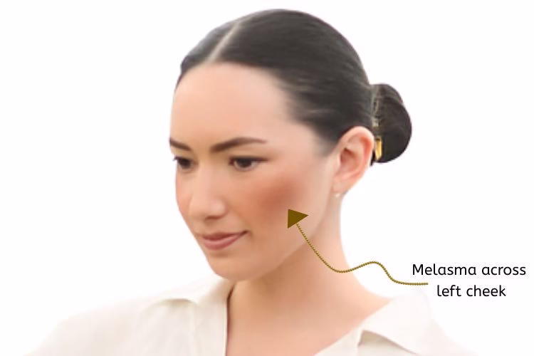 Image showing melasma on a lady's face